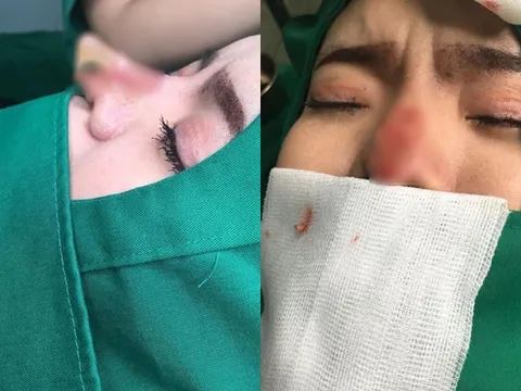 Hoảng sợ trước loạt ảnh nâng mũi hỏng của cô gái trẻ, nhiều chị em nên cân nhắc trước khi thẩm mỹ