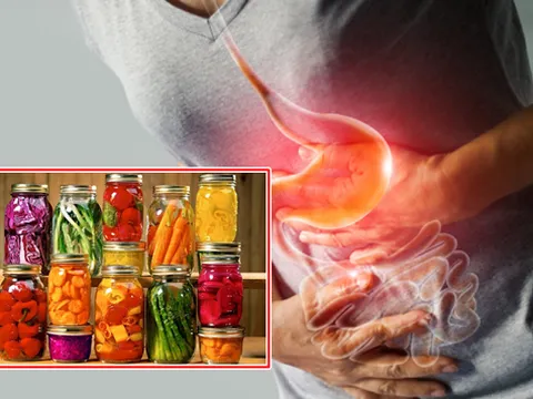 Thói quen ăn uống gây ung thư [2]: Ung thư dạ dày vì ăn thực phẩm ngâm, muối chua