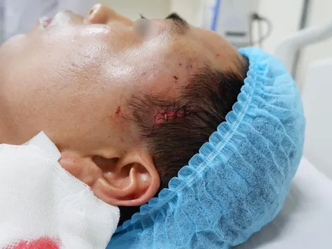 Phẫu thuật độn thái dương, người đàn ông phải cấp cứu vì máu chảy ồ ạt