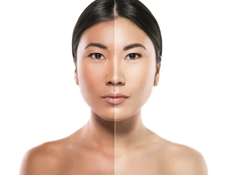 Làm sáng da 'thần tốc' bằng phương pháp tiêm trắng, liệu có an toàn?