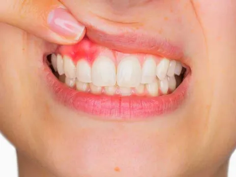 Mẹo trị viêm lợi hiệu quả cho bà bầu, tránh nguy cơ sinh non