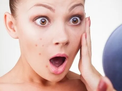 Thuốc trị mụn Myspa 10mg: Hiểu đúng và dùng đúng