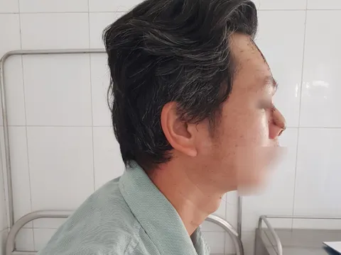 Nốt mụn nhỏ sau 2 tháng hóa ung thư khiến người đàn ông phải cắt bỏ mũi