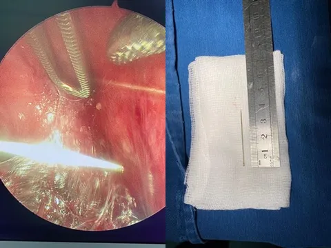 Phẫu thuật nội soi lấy chiếc kim khâu dài 4cm trong lồng ngực bé gái 3 tuổi