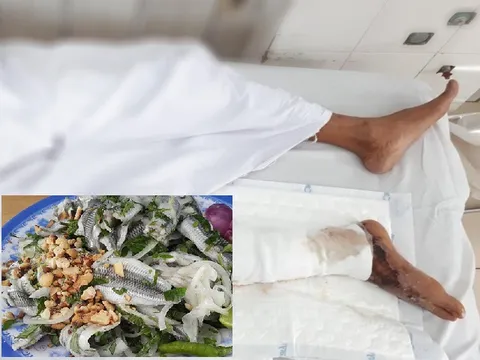 Nhiễm độc 'tả biển' suýt phải cắt một chân vì món gỏi cá rô phi ưa thích 
