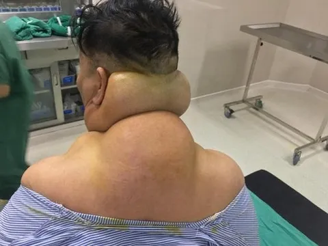 “Sâu rượu” nhiều năm, cơ thể người đàn ông biến dạng, xuất hiện nhiều khối u lớn