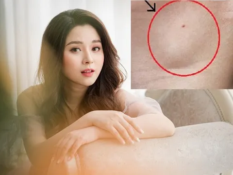Dạng ung thư máu MC Diệu Linh mắc phải dù là thể mạn tính nhưng vì sao lại gây tử vong nhanh?