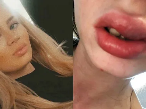Cô gái chung sống với đôi môi sưng phồng, nhiễm trùng máu suốt 3 năm do biến chứng tiêm filler