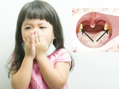Một ca mắc bệnh bạch hầu khiến hàng chục người phải cách ly, căn bệnh này dễ lây lan như thế nào?