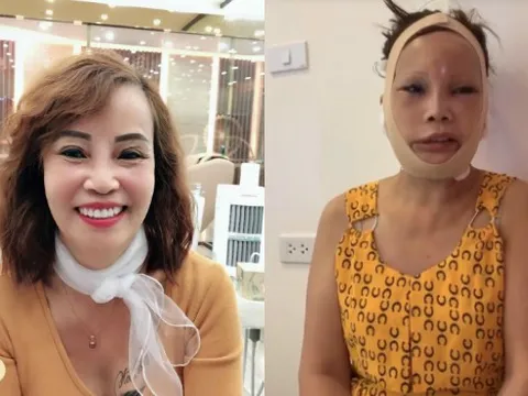 Vừa nâng mũi chưa lâu, cô dâu 62 tuổi lại khiến dân tình hú hồn vì gương mặt sưng vù sau thẩm mỹ 