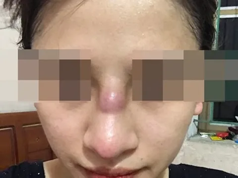 Cô gái 19 tuổi biến chứng nhiễm trùng, suýt thủng vách ngăn sau nâng mũi bằng sụn silicone ở spa