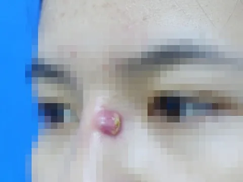 Mụn trứng cá tái đi tái lại 3 tháng trời, vào viện mới biết do nhiễm trùng đặt sụn nâng mũi