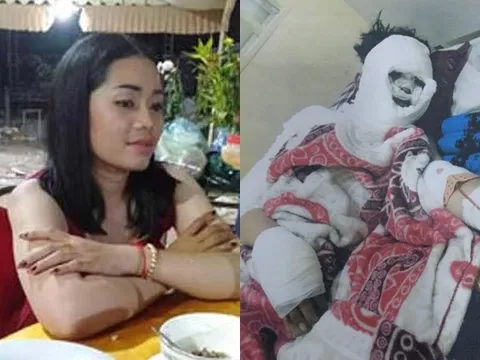 Gã đàn ông cuồng ghen tạt axit, chém bạn gái mất bàn tay trái vì... dám nói lời chia tay