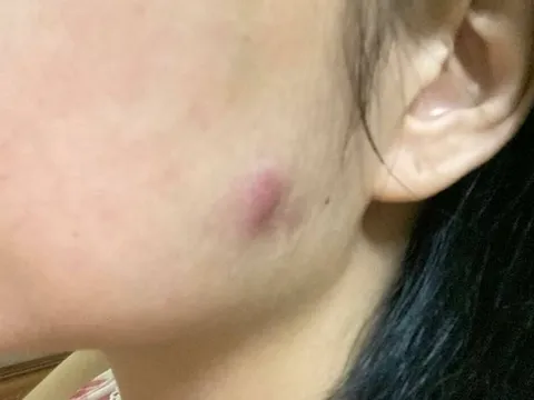 Nổi cục cứng, áp xe vùng má do biến chứng tiêm botox gọn hàm ở tiệm spa