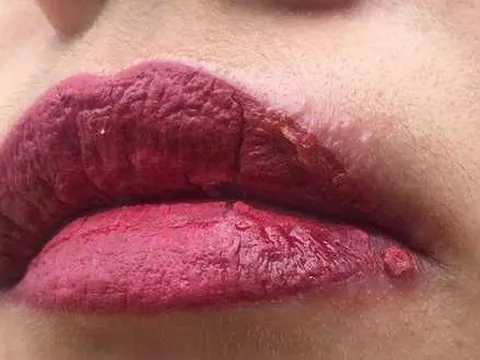 Xăm môi 4 ngày bị đóng vảy, sạm da nhập viện thì phải điều trị kháng sinh cả tháng trời