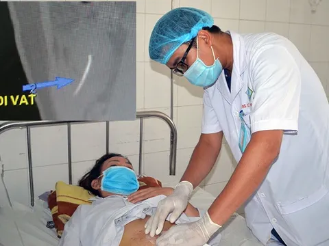 Đau bụng buồn nôn suốt 10 ngày, nhập viện mới biết chiếc xương cá đâm thủng ruột