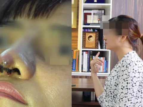 Cầu cứu bác sĩ với chiếc mũi đứt lìa, hoại tử trầm trọng sau 12 ngày nâng mũi 'dạo'