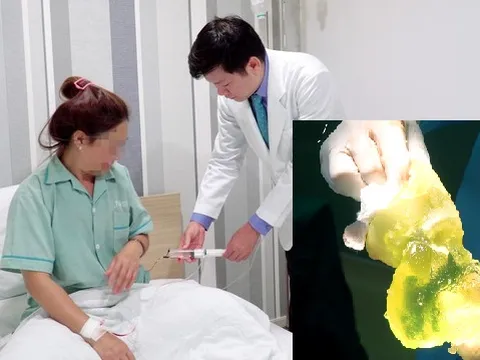 Bàng hoàng phát hiện vỡ túi nâng ngực sau nhiều năm chịu cảnh ngứa râm ran và thâm tím vùng ngực
