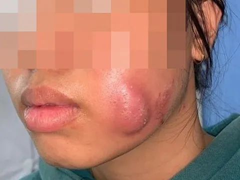 Thiếu nữ phải chịu vết sẹo lõm sau tạo má lúm đồng tiền vì chủ quan cứ ngỡ là sâu răng