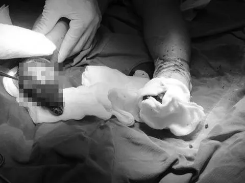 Ám ảnh bé trai 17 tháng tuổi nhiễm trùng nặng hai bàn chân vì cha mẹ đắp lá chữa bỏng