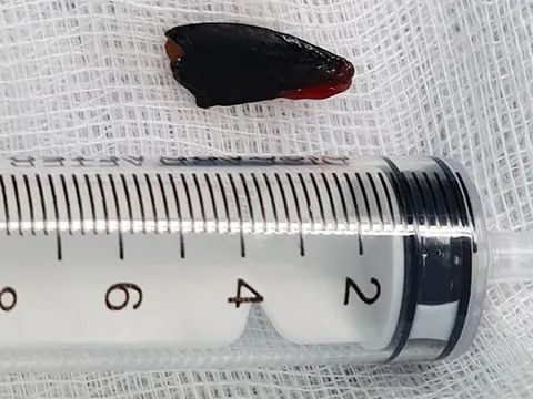 Bàng hoàng phát hiện hạt hồng xiêm nằm trong phế quản cô gái gây ho suốt 27 năm