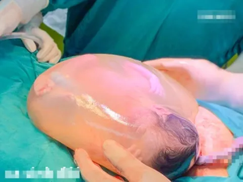 Mẹ bầu song thai vỡ ối sinh non, bác sĩ lấy ra một trong hai em bé còn nguyên trong bọc ối