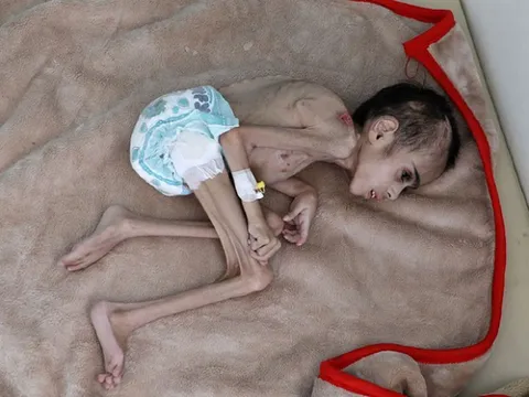 Cậu bé Yemen 7 tuổi chỉ nặng 7 kg vì nạn đói