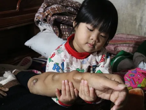 Nghẹn ngào cảnh bé gái quấn quýt, sờ nắn khối u trên tay người cha khao khát sự sống