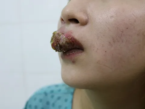 Xăm môi đón Tết, cô gái trẻ nhận cái kết đắng khi môi sưng phù như 'mỏ chim'