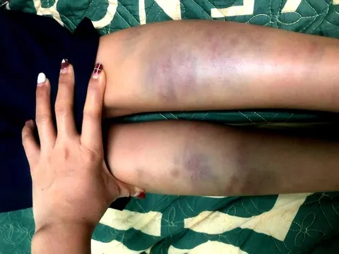 Tá hỏa vì con bị đánh bầm tím, mẹ bức xúc khi nghe cô giáo trả lời