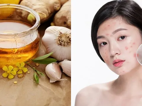 Cách trị mụn hiệu quả, nhanh chóng