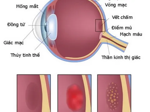 Những yếu tố tăng nguy cơ thoái hóa điểm vàng