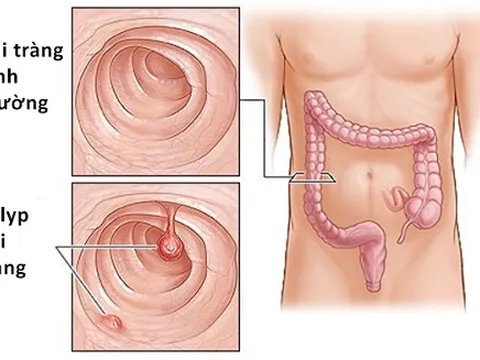 Phòng ngừa táo bón ở người cao tuổi