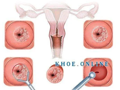 Viêm lộ tuyến tử cung không thể xem thường