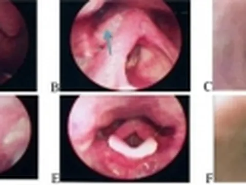 Hút thuốc lá nhiều năm dễ bị ung thư xoang lê