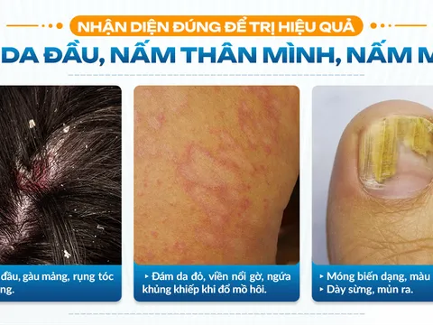 Top 3 nơi trị nấm da uy tín TPHCM: Nấm da đầu, nấm thân mình, nấm móng