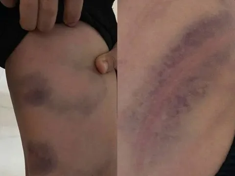 Bé trai ở Bắc Ninh bị cha đánh bầm tím vì lười học