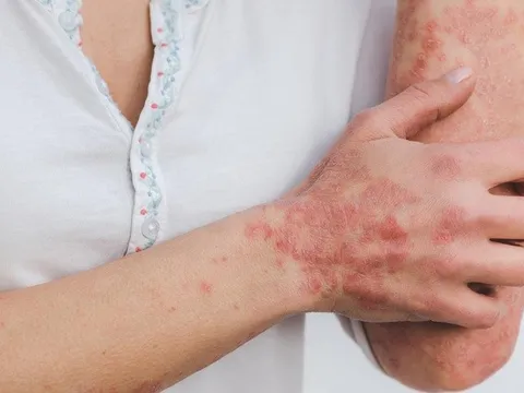 Có nên tự dùng thuốc để điều trị bệnh vảy nến
