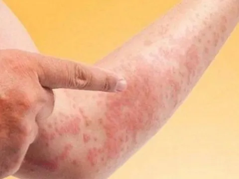 Nguyên nhân khiến bệnh ngoài da dai dẳng và dễ tái phát