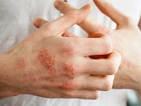 Chữa bệnh chàm nhanh nhất ở Bảo Thanh Đường