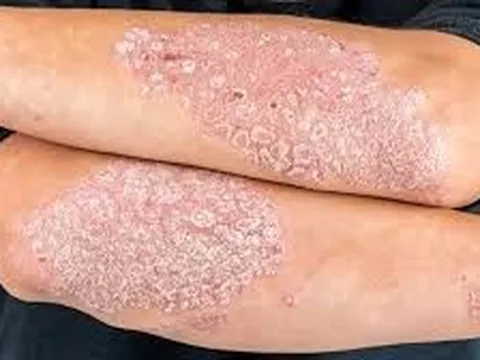Bệnh Vảy Nến: Phân Tích Toàn Diện Về Mức Độ Nguy Hiểm Và Các Giải Pháp Điều Trị Hiện Đại