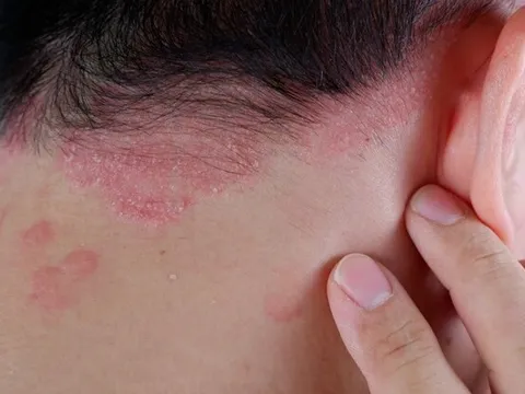 Điều trị sớm bệnh vẩy nến tránh nguy cơ biến chứng