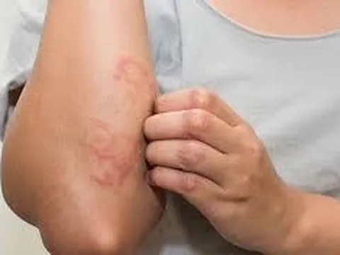 Khỏi Viêm Da Cơ Địa Đeo Bám Hơn Chục Năm Bằng Phương Thuốc Từ Thảo Dược