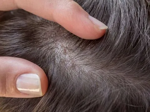 Bảo Thanh Đường - Điều trị dứt điểm bệnh viêm chân tóc