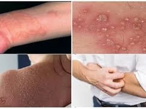Bảo Thanh Đường - Địa chỉ uy tín chữa tận gốc bệnh chàm (eczema)
