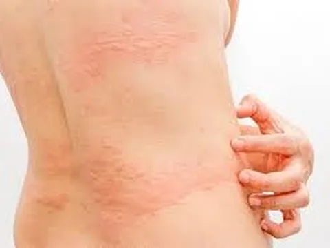 Nổi mề đay sau sinh: Nguyên nhân, Triệu chứng và Giải pháp điều trị