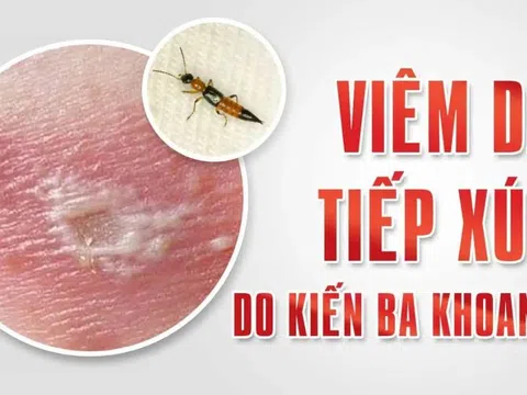 Viêm da tiếp xúc do kiến ba khoang nguy hiểm như thế nào?