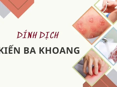 Cách xử lý khi dính dịch kiến ba khoang nhanh chóng, tránh đau đớn