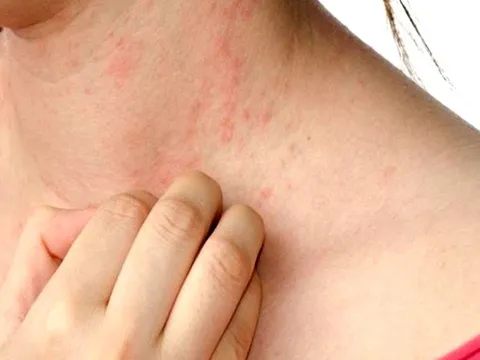 “Tôi đã từng nghĩ mình phải sống chung với bệnh mề đay suốt đời…”