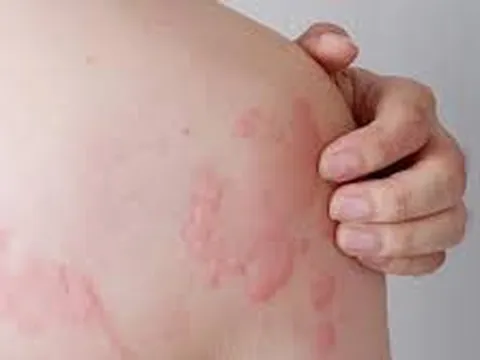 Nổi mề đay sau sinh: Nguyên nhân, Triệu chứng và Giải pháp điều trị
